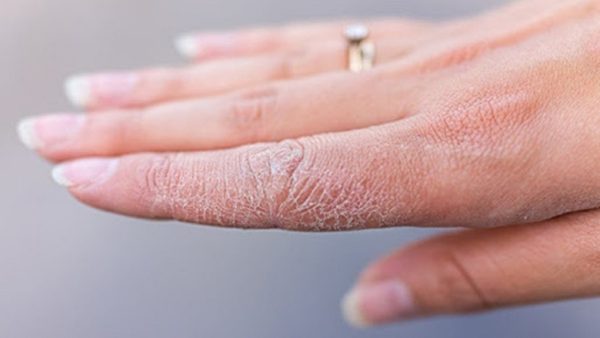 علائم دیابت از روی پوست
