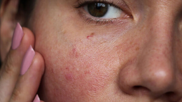 تغییرات پوستی که خبر از بیماری جدی در بدن می دهند!