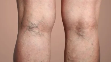 جلوگیری از واریس